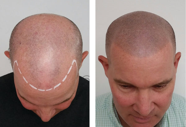 What is Scalp Micropigmentation (SMP)?